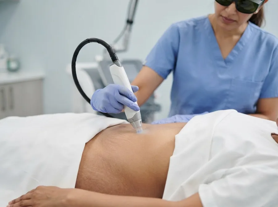 A laser handpiece treating pale stretch marks on a draped hip