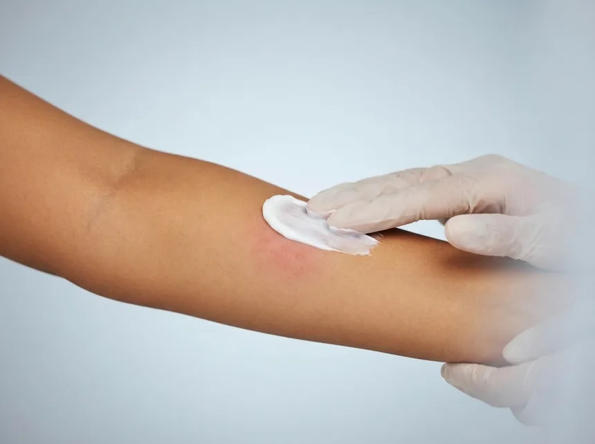 Barrier cream being smoothed onto irritated skin on a forearm