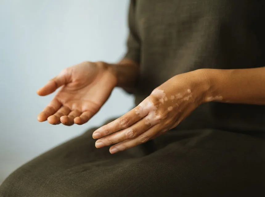 Open hands showing pale depigmented vitiligo patches