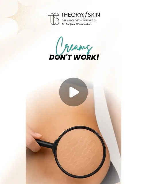 Reel about stretch marks treatment, from Theory of Skin, Indiranagar