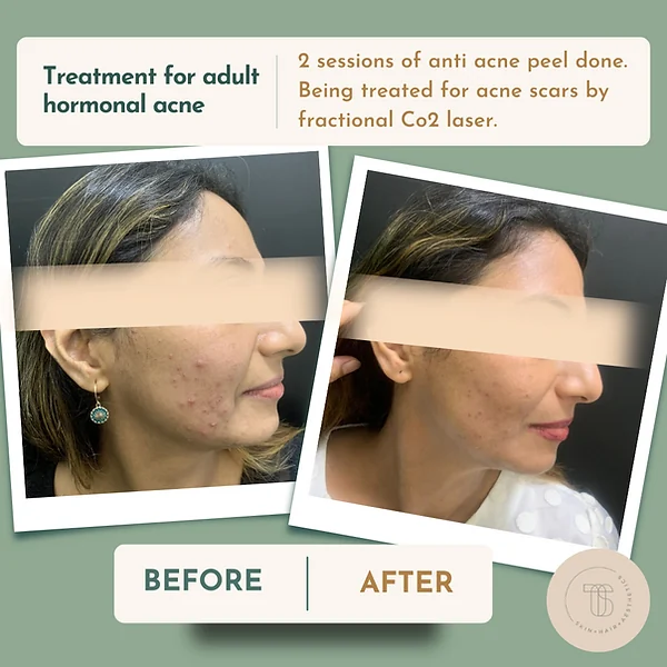 Acne peel and CO2 laser result at Theory of Skin